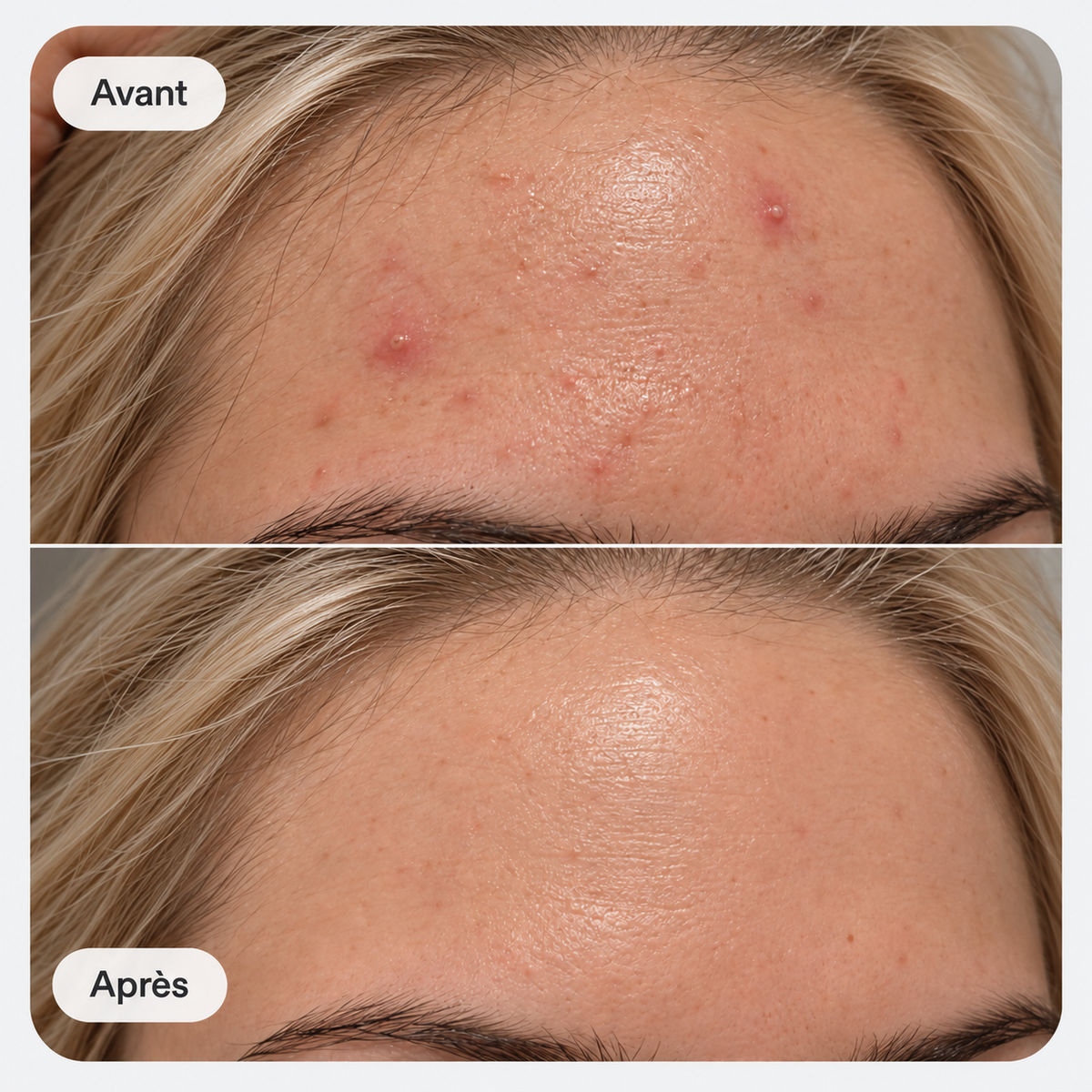 Infammed acne