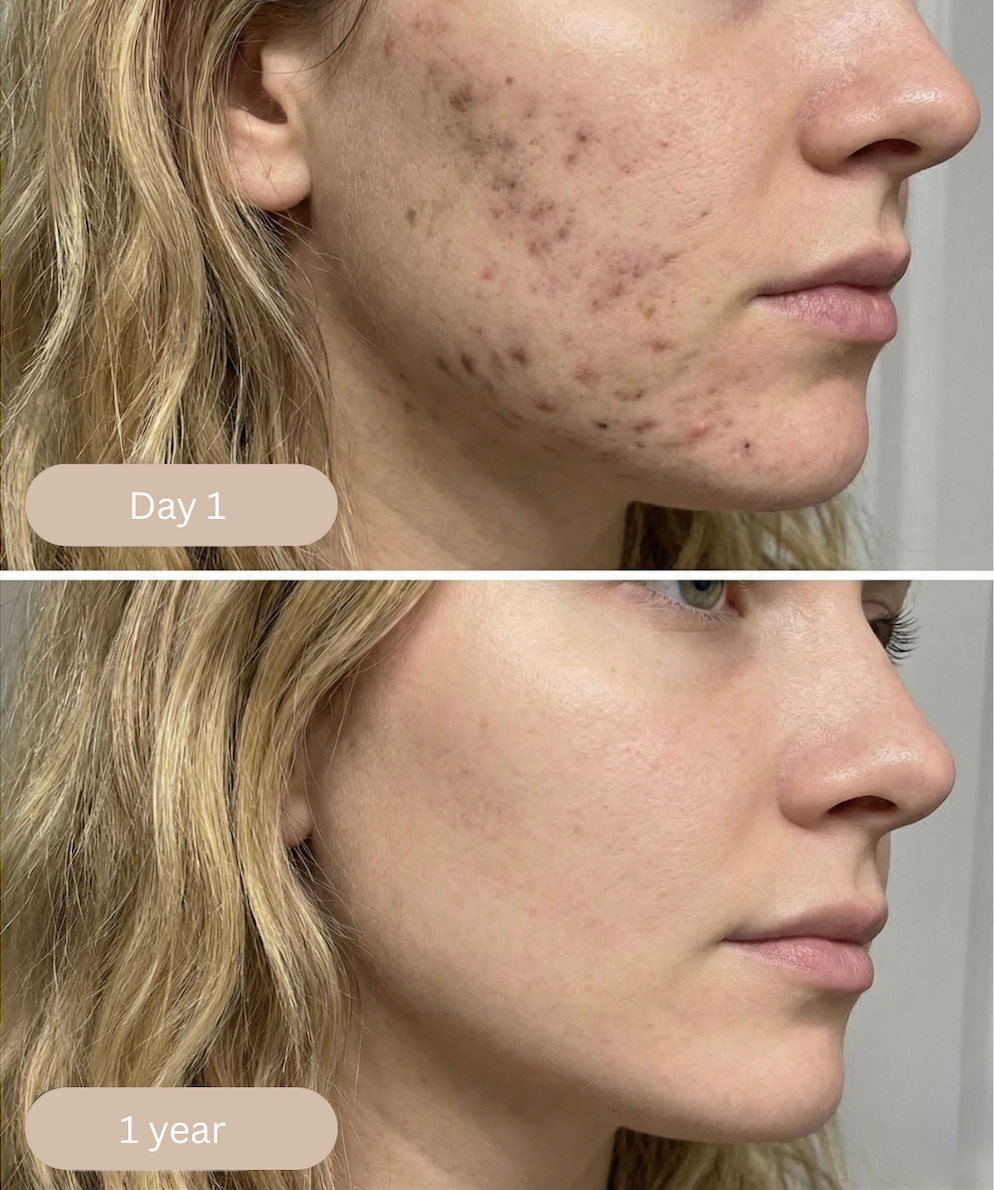 Inflammed acne and scars