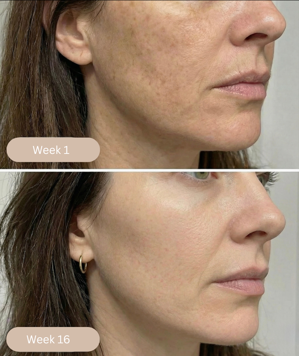 Pigmentation