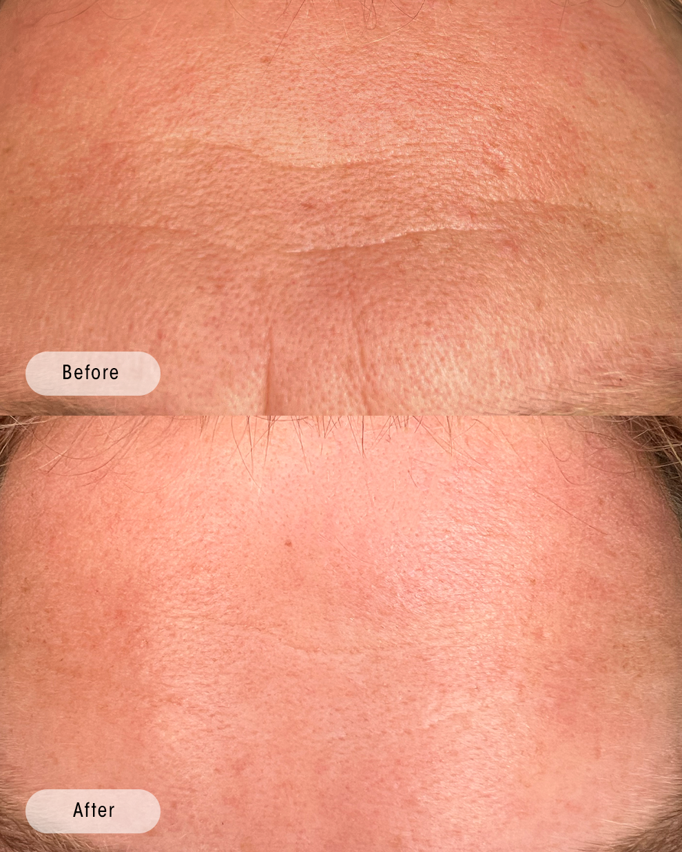 Forehead rejuvenation