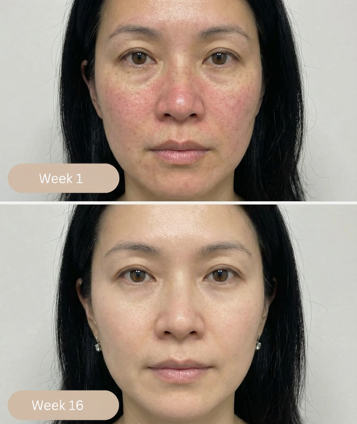 Redness - Uneven skin ton